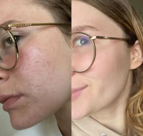 Masajeador e Tonificador Facial Quita Papada